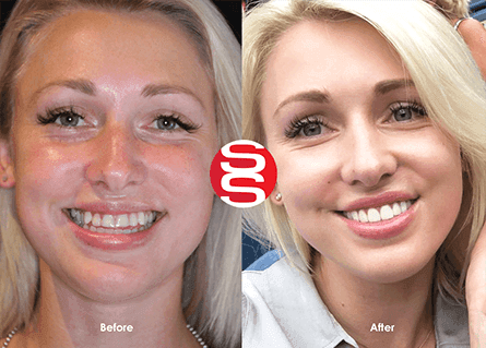 Caroline Before After